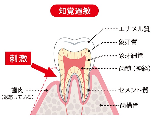 ホワイトニングによる知覚過敏の原因
