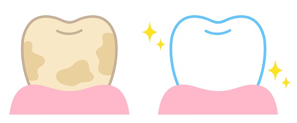 ホワイトニングで歯が白くなる仕組み